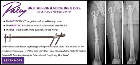 Stature Lengthening Paley Orthopedic And Spine Institute