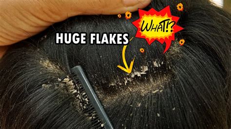 Huge Dandruff Flakes In Hair Removal Dandruff Scratching Satisfying