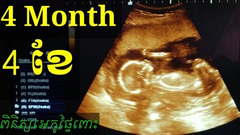 ពិនិត្យឣេកូផ្ទៃពោះ 4ខែ Pregnancy Ultrasound 4month By Drbun Laysophea