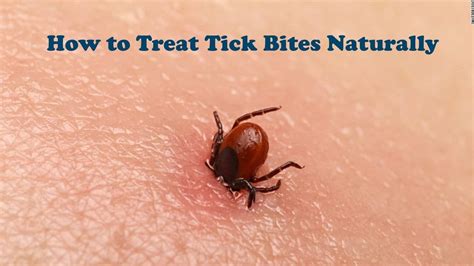 How To Treat A Tick Bite The Housing Forum