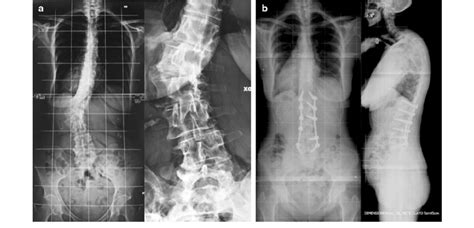 A B Type Iii Dsd In Adult De Novo Lumbar Scoliosis After A Minimally