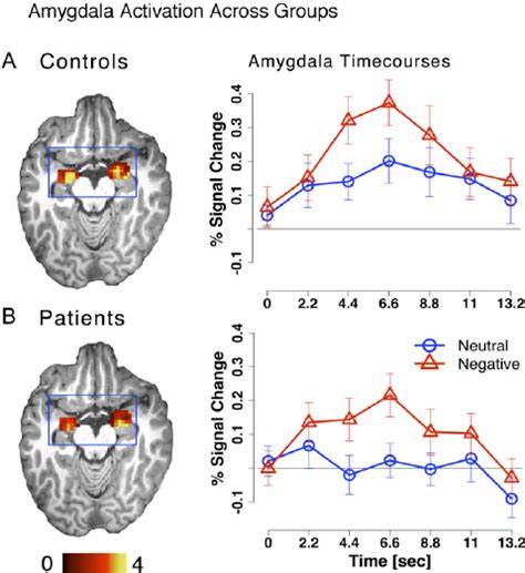 Amygdala Activation Is Shown For A Controls And B Patients With The