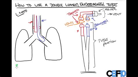 How To Use A Double Lumen Endotracheal Tube Youtube