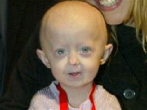 Hutchinson Gilford Progeria Syndrome What Is It And How Does It Affect