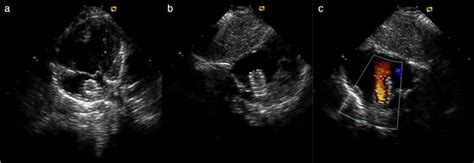 Transthoracic Echocardiography Of A Patient With Hypoplastic Left Heart