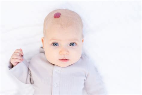 Hemangioma Infantil O Que é E Qual Tipo De Tratamento Indicado