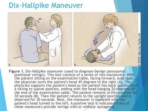 95 Dix Hallpike Test And Epley Maneuver Pictures