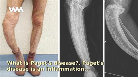 What Is Paget S Disease Youtube