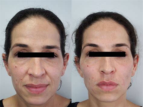 Dermal Fillers Before And After Photos Palm Clinic