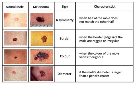 Skin Cancer In South Africa Bti