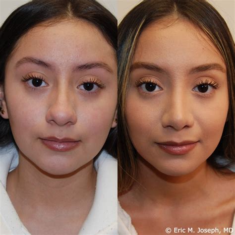 Eric M Joseph MD Rhinoplasty Before After Wide Tip Reduction
