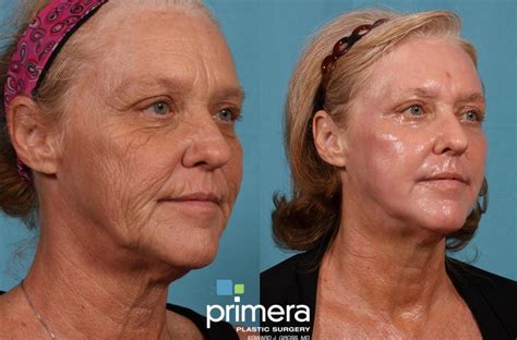 Before And After Photos Of Deep Chemical Peel Phenol Peel By Expert