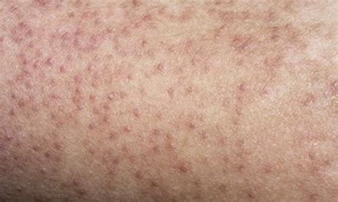 Does Your Child Have Keratosis Pilaris Or Chicken Skin Learn How To