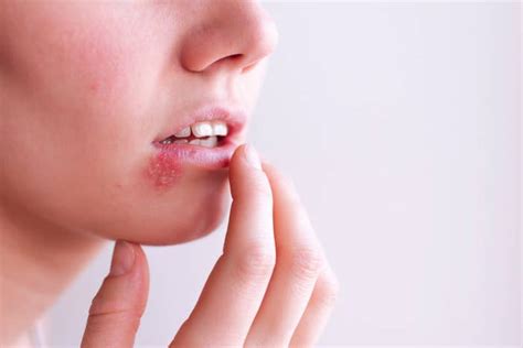 Heres What You Need To Know About Cold Sores And Herpes