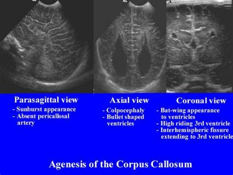 Agenesis Of Corpus Callosum Ultrasound Diagnostic Medical Sonography