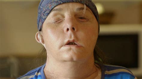 The Story Behind This Woman S Face Transplant Is Simply Incredible