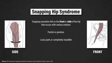 Snapping Hip Syndrome E3 Rehab