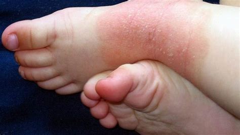 Dermatite Atopica Cos Quali Sono I Sintomi E Come Si Cura Questa Malattia Della Pelle