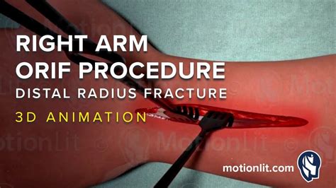 Right Arm Orif Procedure Of Distal Radius Fracture 3d Medical