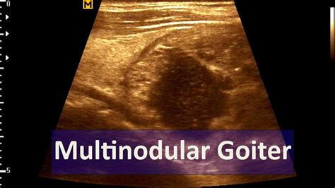 Ultrasound Cases 52 Of 2000 Video Showing Multinodular Goiter Youtube