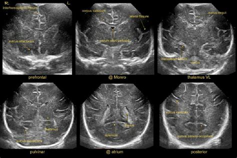 Coronal Sections Imaging Through Anterior Fontanel At Standard Coronal