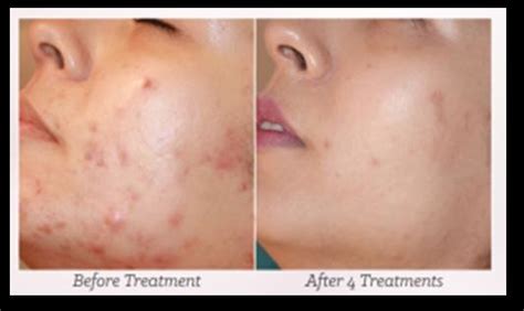Mesotherapy For Acne Before And After Treatment Download Scientific