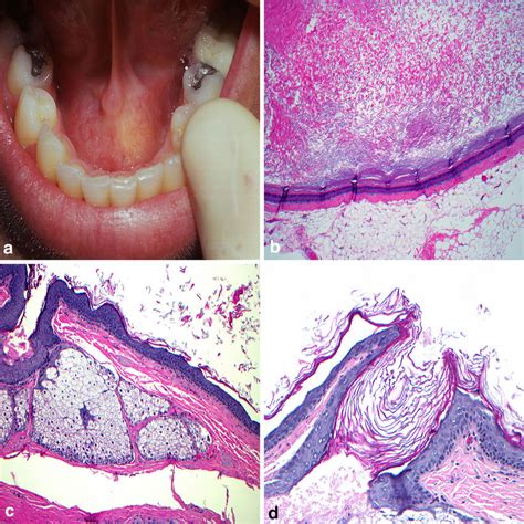 Dermoid Cyst A Fluctuant Swelling At Midline Of The Floor Of Mouth B