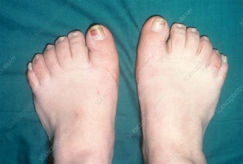 Human Feet With 6 Toes Stock Image C0502711 Science Photo Library