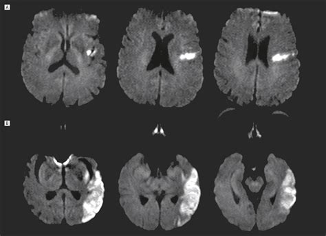 Insular Cortex Infarction In Acute Middle Cerebral Artery Territory