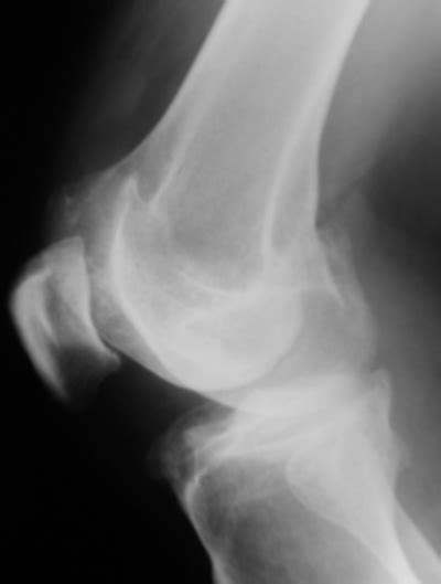 Anteroposterior radiograph showing soft tissue calcification adjacent to the medial femoral condyle (arrow). Internet Scientific Publications