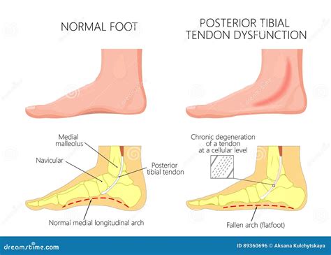 Medial Ankle Injury Posterior Tibial Tendon Dysfunction Vector