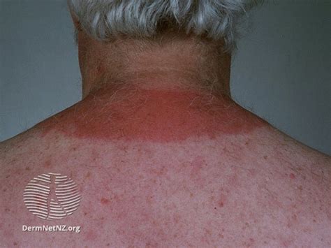 Itchy Red Rash After Sun Exposure Onmedica