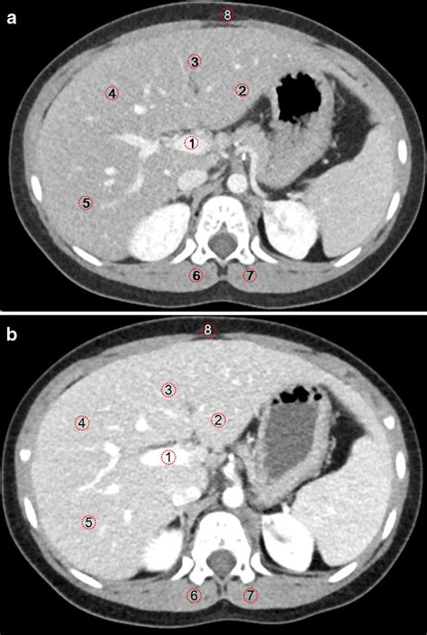 Axial Contrast Enhanced Portal Phase Computed Tomography Ct Images