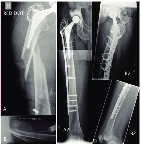 Pre Op X Rays A Anteroposterior And B Lateral Of The Hip With