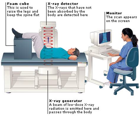 Assess why the person may have told the lie. Medical Encyclopedia - Test: Bone Densitometry - Aviva