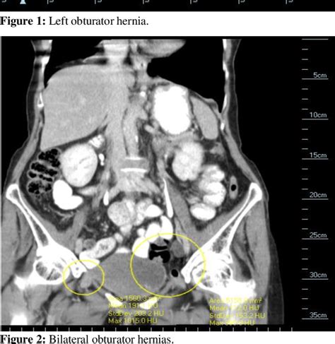 Figure 2 From A Rare Case Of Bilateral Incarcerated Obturator Hernias