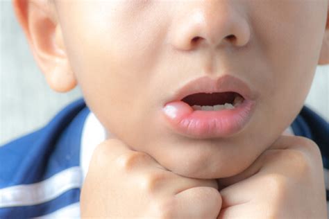 14 Common Causes Of Swollen Lips
