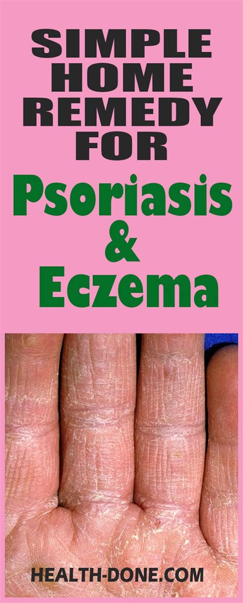 Natural And Simple Home Remedy For Psoriasis And Eczema You Cannot