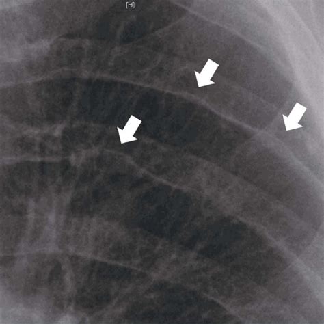 Pdf Coarctation Of Aorta With Complete Aortic Occlusion