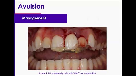 Cpd 13 Traumatic Dental Injuries Part 2 Luxation Injuries Type 6