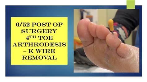 Video K Wire Removal From 4th Toe Surgery Youtube