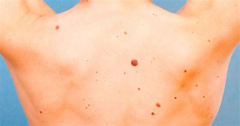 How To Tell If Moles Are Skin Cancer Teen Vogue