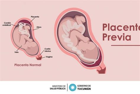 ¿cuáles Son Las Causas Y Los Síntomas De La Placenta Previa En El Embarazo Comunicación Tucumán