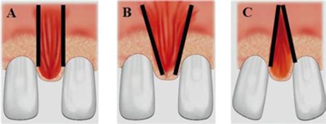 Classification Of Upper Lip Frenula According To Monti A Elongated
