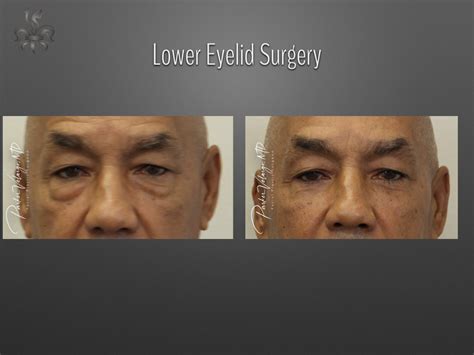 Blepharoplasty Eyelid Surgery Case 4331 New Orleans Premier Center