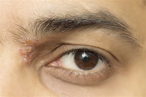Herpes Zoster Shingles Of The Eye Treatment Boston Ma Near Me Cost