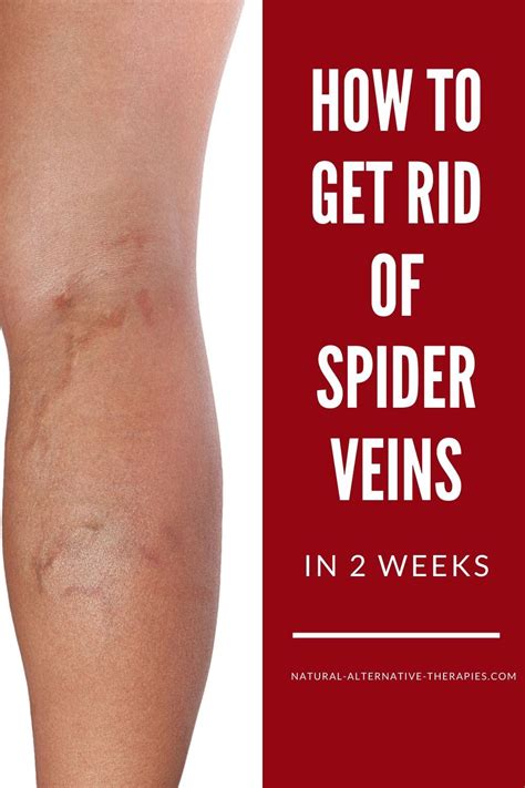 How To Get Rid Of Spider Veins Naturally In 2 Weeks Get Rid Of