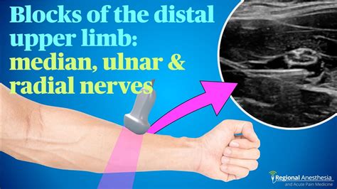 Ultrasound Guided Blocks Of The Median Ulnar And Radial Nerves Youtube