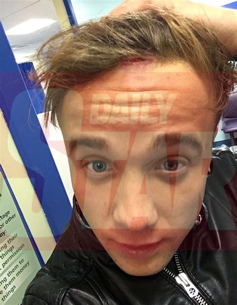 X Factor Sam Callahan Skull Slashed Open In Brutal Gang Attack There