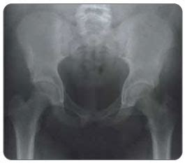 Musculoskeletal anatomy, kinesiology, and palpation for manual therapists. Hamstring Pull Diagnosis